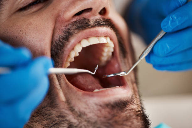 Best Emergency Wisdom Tooth Extraction in Collinsvle, IL